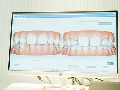 治療期間や治療後の歯並びのイメージを事前に確認することができます